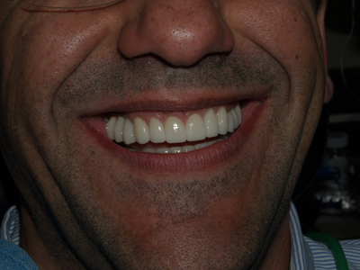 After Dental Implants