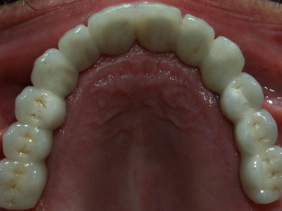 After implants and silver filling replacement