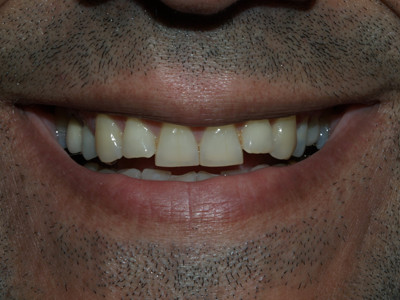 Before Dental Implants