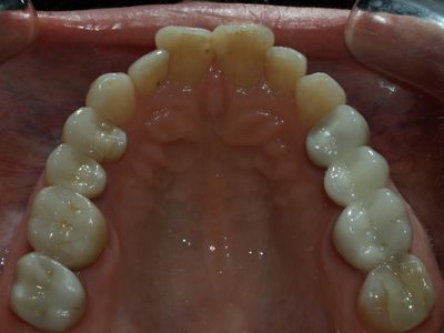 after silver fillings removed and replaced with safe composites