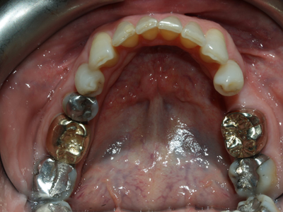 before metal filling removal