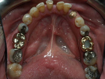 before amalgam filling removal