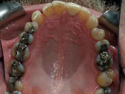 before amalgam filling removal